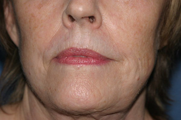 Croton Peel Before & After Patient #2239