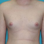 Gynecomastia Before & After Patient #1938