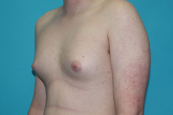 Gynecomastia Before & After Patient #1938