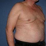 Gynecomastia Before & After Patient #1947