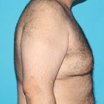 Gynecomastia Before & After Patient #1962