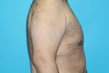 Gynecomastia Before & After Patient #1962
