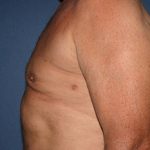 Gynecomastia Before & After Patient #1955
