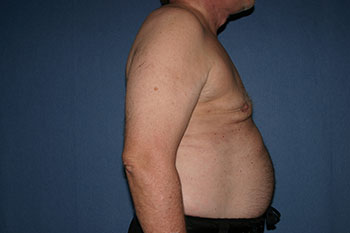 Gynecomastia Before & After Patient #1947