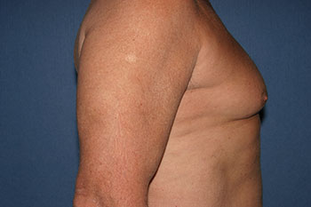Gynecomastia Before & After Patient #1955