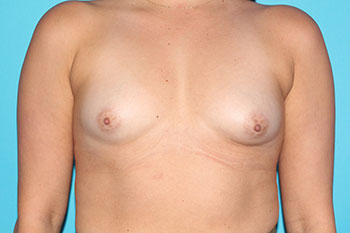 Breast Augmentation with Implant Before & After Patient #1853