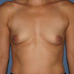 Breast Augmentation with Implant Before & After Patient #1860