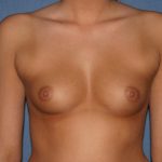 Breast Augmentation with Implant Before & After Patient #2166