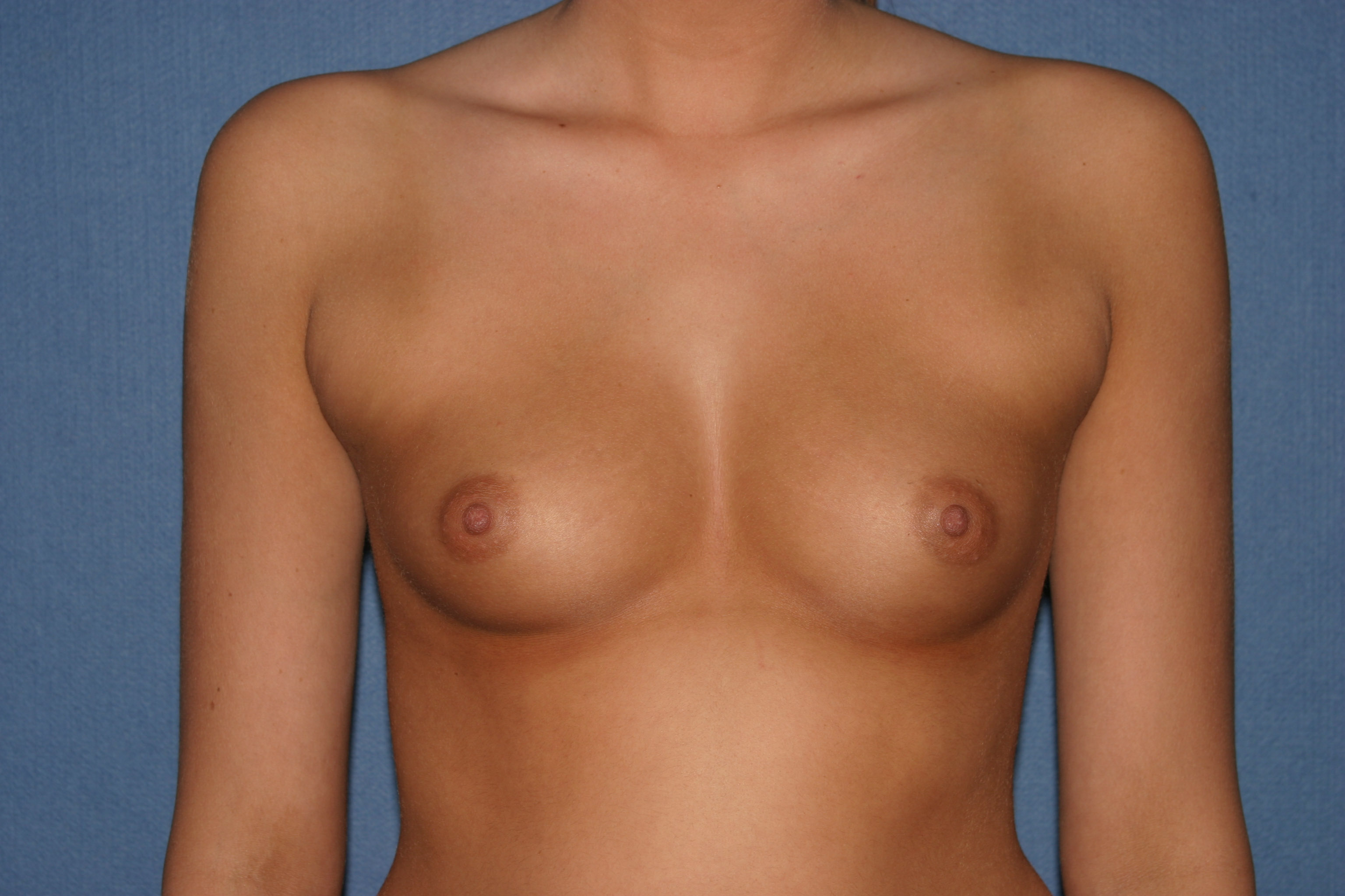 Breast Augmentation with Implant Before & After Patient #2166