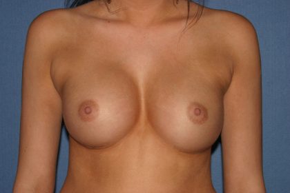 Breast Augmentation with Implant Before & After Patient #2166