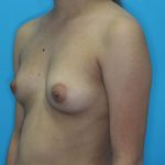 Breast Augmentation with Implant Before & After Patient #1871