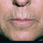 Laser Resurfacing Before & After Patient #2315