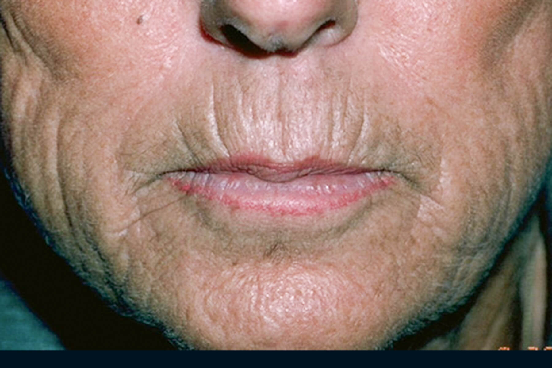Laser Resurfacing Before & After Patient #2315