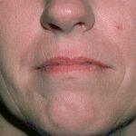 Laser Resurfacing Before & After Patient #2318