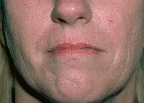 Laser Resurfacing Before & After Patient #2318