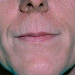 Laser Resurfacing Before & After Patient #2321