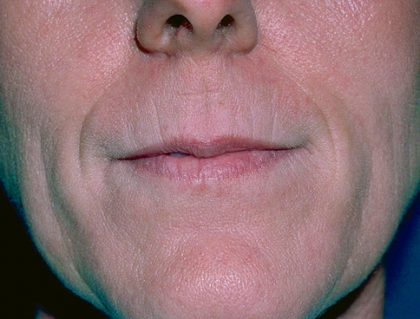 Laser Resurfacing Before & After Patient #2321