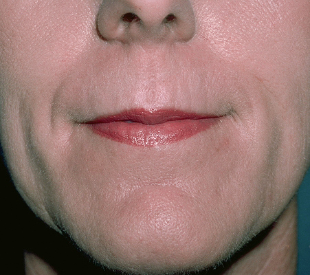 Laser Resurfacing Before & After Patient #2321