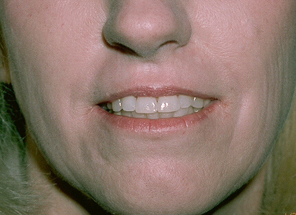 Laser Resurfacing Before & After Patient #2318