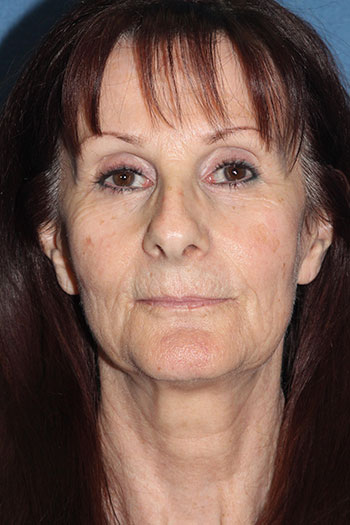 Laser Resurfacing Before & After Patient #2035