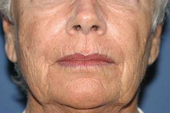 Laser Resurfacing Before & After Patient #2038