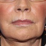Laser Resurfacing Before & After Patient #2038