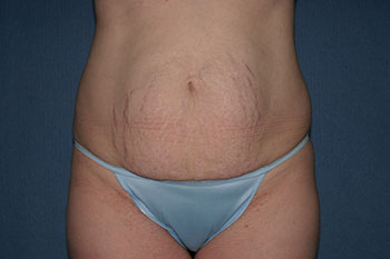 Tummy Tuck (Lipoabdominoplasty) Before & After Patient #1778