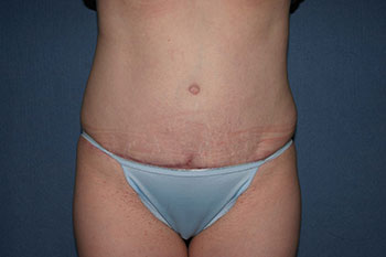 Tummy Tuck (Lipoabdominoplasty) Before & After Patient #1778