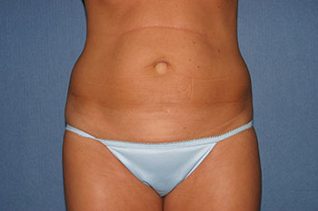Tummy Tuck (Lipoabdominoplasty) Before & After Patient #1785