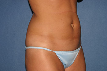 Tummy Tuck (Lipoabdominoplasty) Before & After Patient #1785