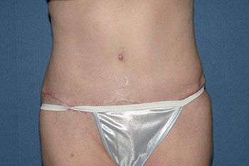 Tummy Tuck (Lipoabdominoplasty) Before & After Patient #1793
