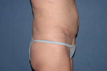 Tummy Tuck (Lipoabdominoplasty) Before & After Patient #1793