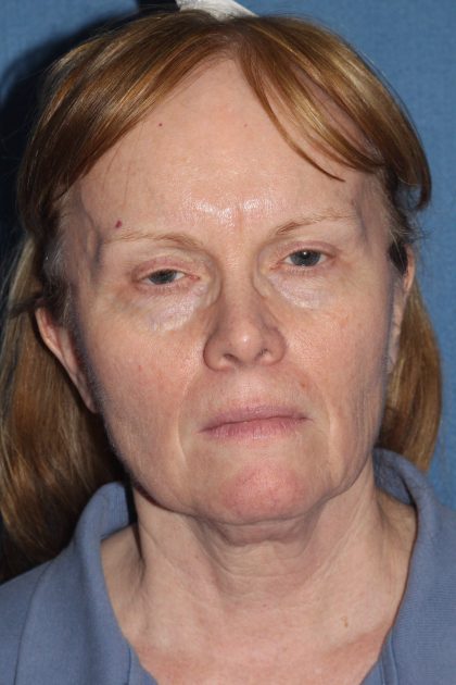Facelift Before & After Patient #2219