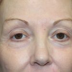 Eyelid Lift Before & After Patient #2260