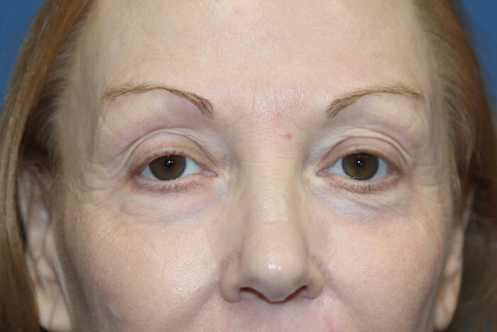 Eyelid Lift Before & After Patient #2260