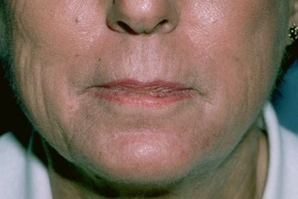 Laser Resurfacing Before & After Patient #2315