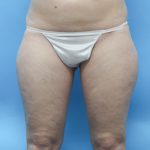 Power Assisted Liposuction Before & After Patient #2155