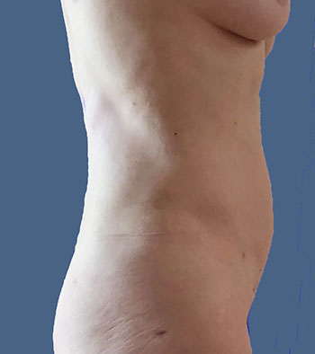 Power Assisted Liposuction Before & After Patient #1819