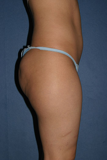 Power Assisted Liposuction Before & After Patient #1822