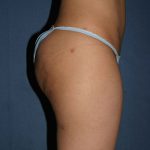 Power Assisted Liposuction Before & After Patient #1822