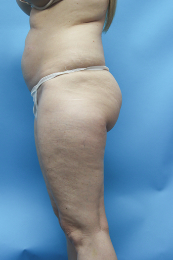 Power Assisted Liposuction Before & After Patient #2155