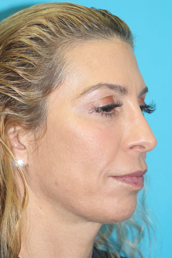 Rhinoplasty Before & After Patient #2097
