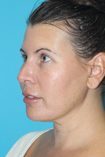 Rhinoplasty Before & After Patient #2134