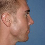 Rhinoplasty Before & After Patient #2073