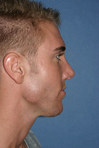 Rhinoplasty Before & After Patient #2073