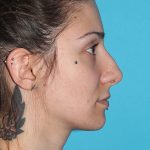 Rhinoplasty Before & After Patient #2080