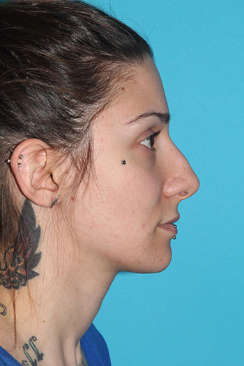 Rhinoplasty Before & After Patient #2080
