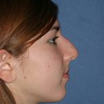 Rhinoplasty Before & After Patient #2085