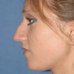 Rhinoplasty Before & After Patient #2090