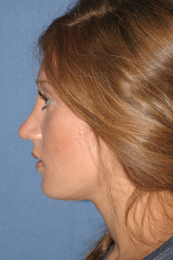 Rhinoplasty Before & After Patient #2090